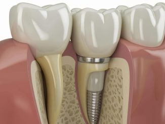 Les atouts à considérer pour choisir le bon implant dentaire