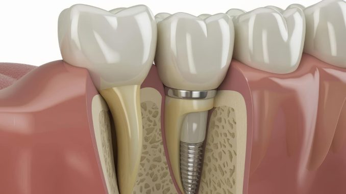 Les atouts à considérer pour choisir le bon implant dentaire